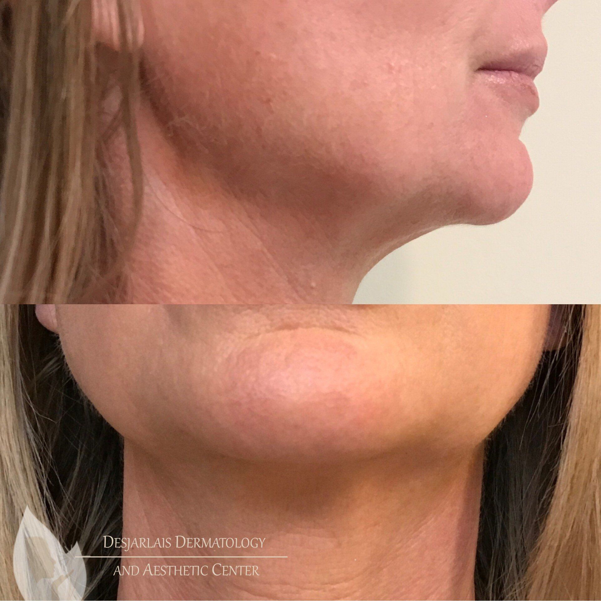 Ultra Morpheus Before Image at Dr. Desjarlais' Office in Adrian, MI
