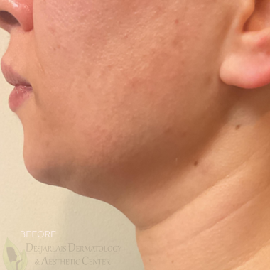 XERF Before Image at Dr. Desjarlais' Office in Adrian, MI