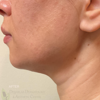 XERF After Image at Dr. Desjarlais' Office in Adrian, MI