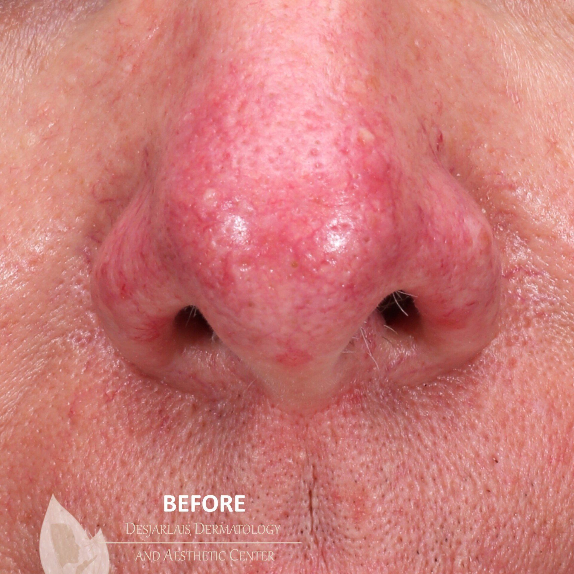 DermaV Before Image at Dr. Desjarlais' Office in Adrian, MI