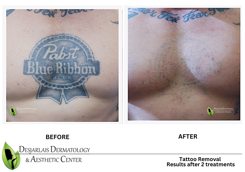 A tattoo removal before and after photo of a man 's chest with a tattoo