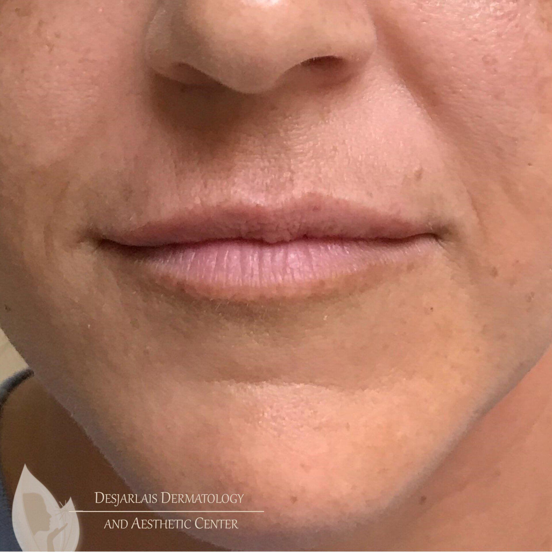 Lip Filler After Image at Dr. Desjarlais' Office in Adrian, MI