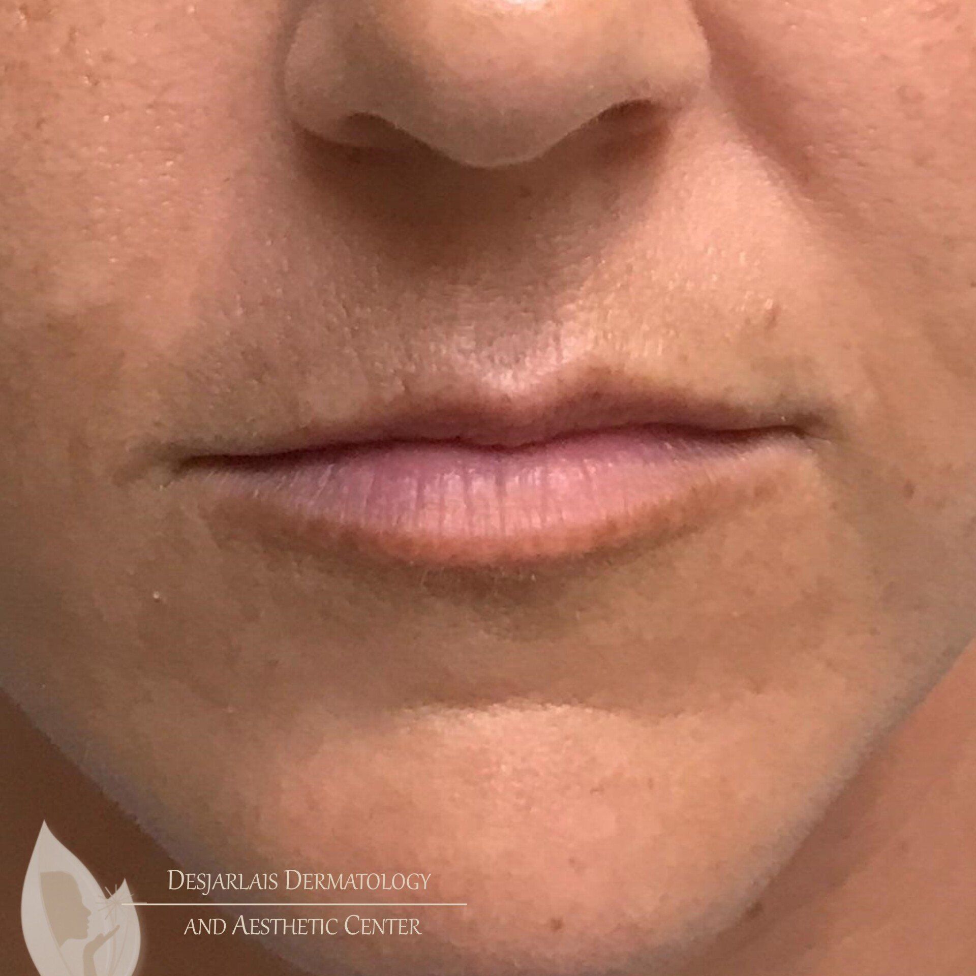 Lip Filler Before Image at Dr. Desjarlais' Office in Adrian, MI