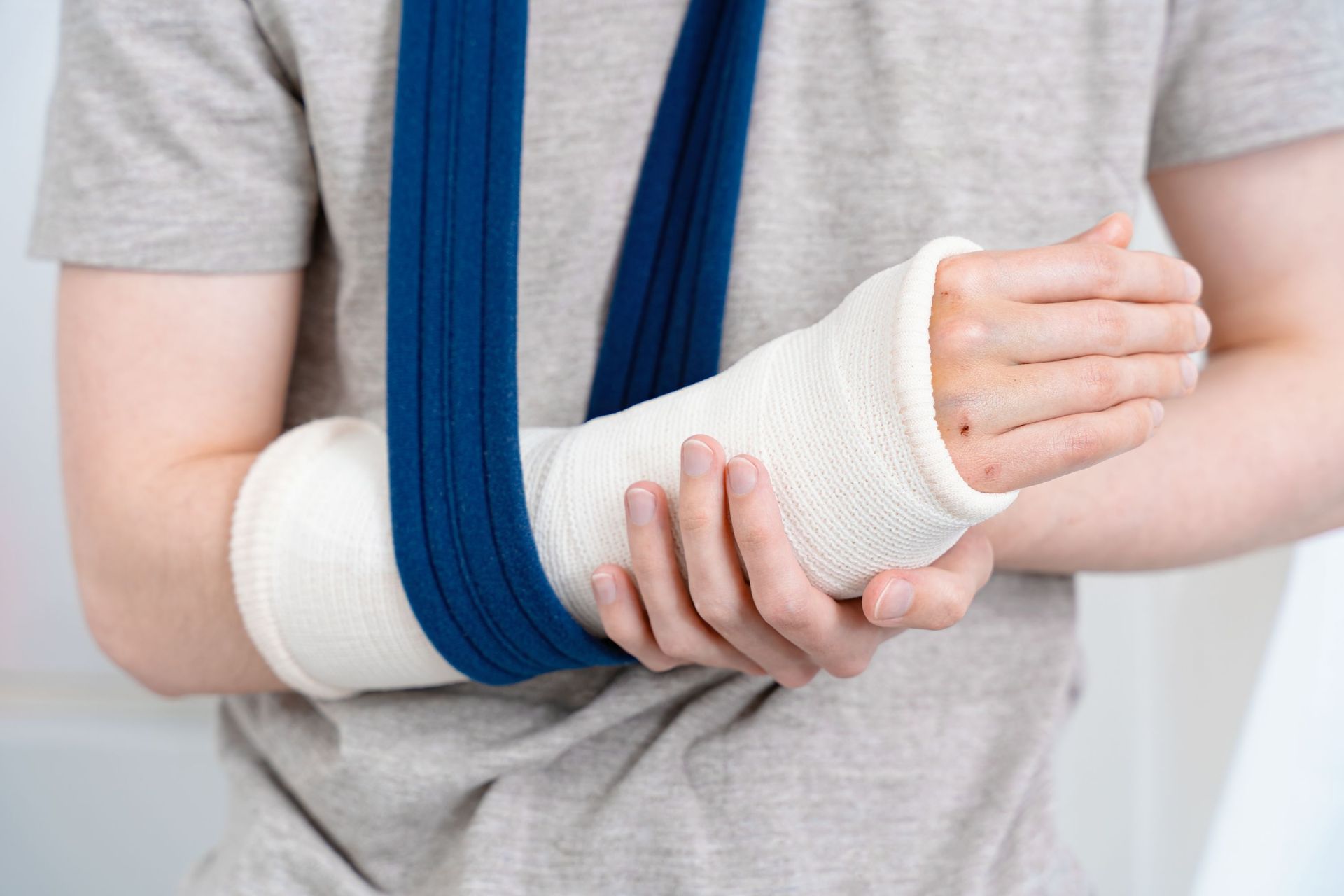 A person wearing a white arm cast supported by a blue sling around their neck.