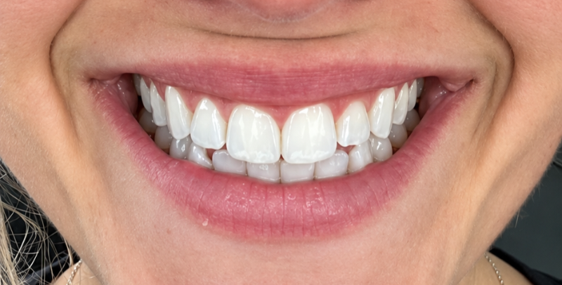Close-up of a smiling mouth with white teeth and pink lips