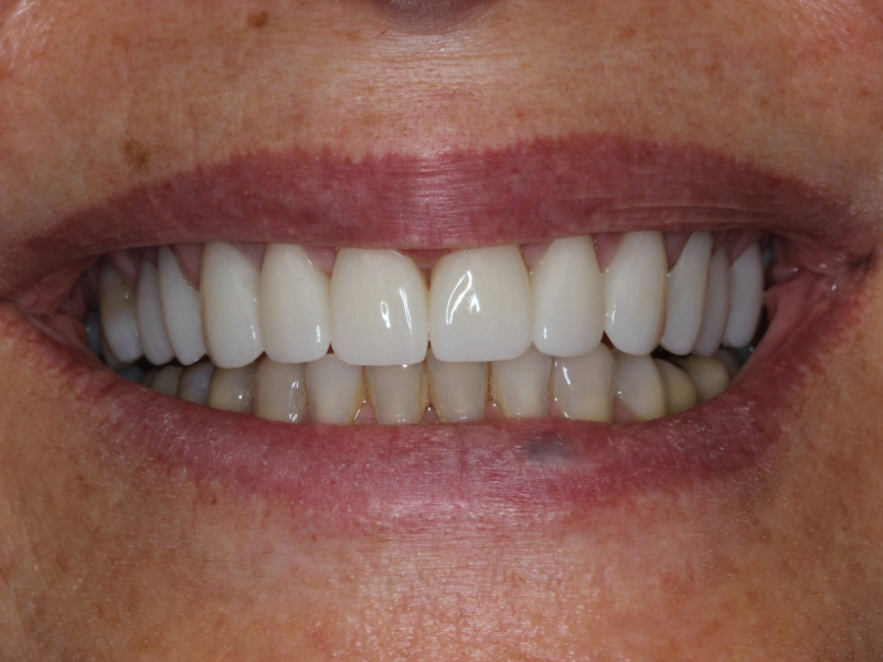 Veneers After - Romano Smile Miami, Florida