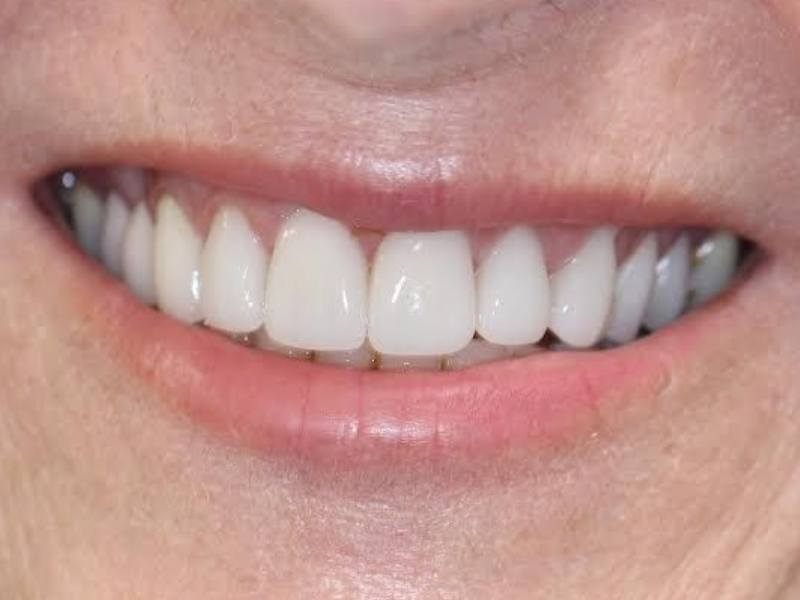 Close-up of a smiling mouth with white teeth and pink lips
