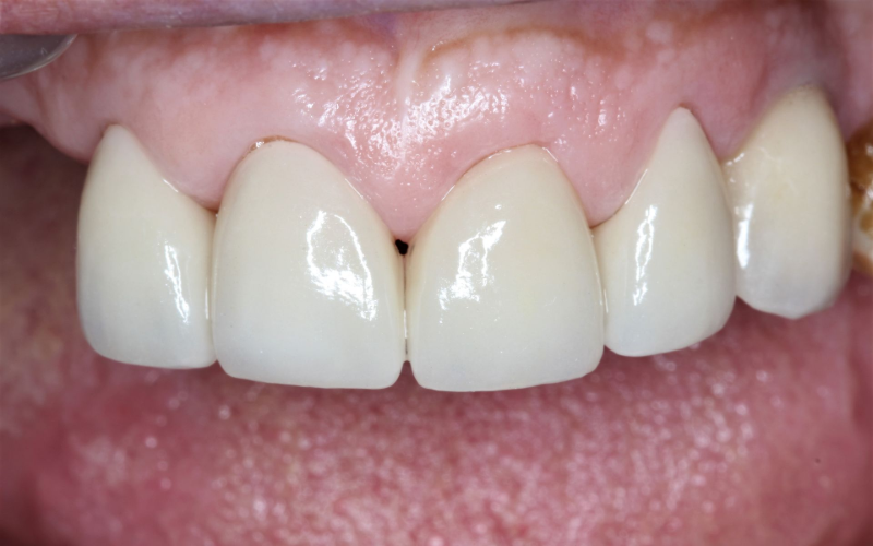 Crowns After - Romano Smile Miami, Florida