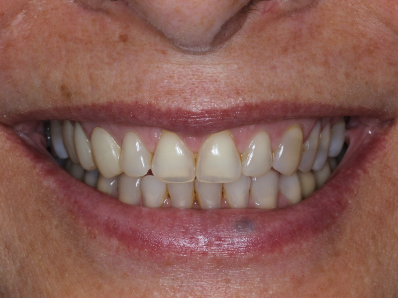 Veneers Before - Romano Smile Miami, Florida