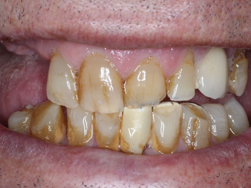 Crowns Before - Romano Smile Miami, Florida