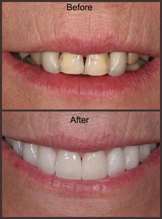 Before and after photos of a person's teeth. 