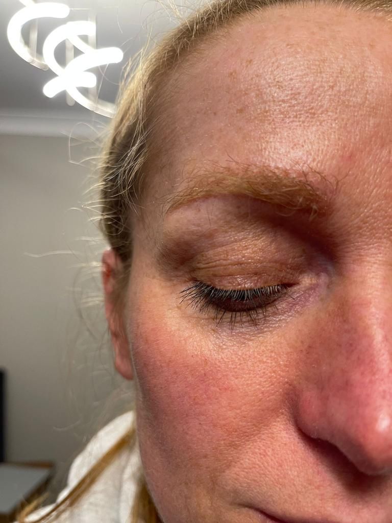 A picture of a female after undergoing an eyebrow hair transplant with Newcastle hair transplant clinic