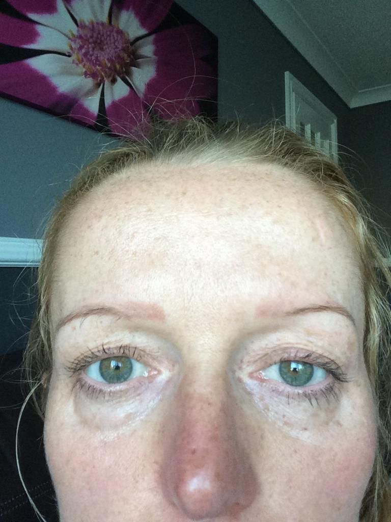 A picture of a female before undergoing an eyebrow hair transplant with Newcastle hair transplant clinic