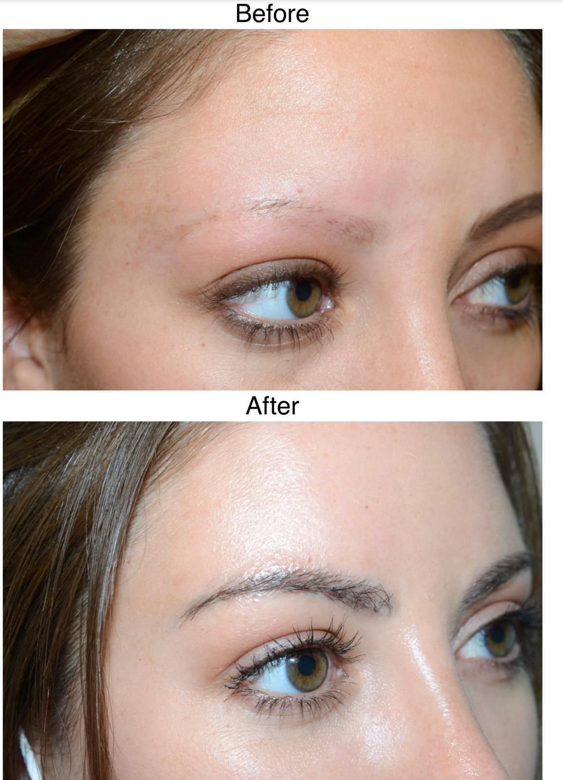 A picture of a female before and after undergoing an eyebrow hair transplant with Newcastle hair transplant clinic