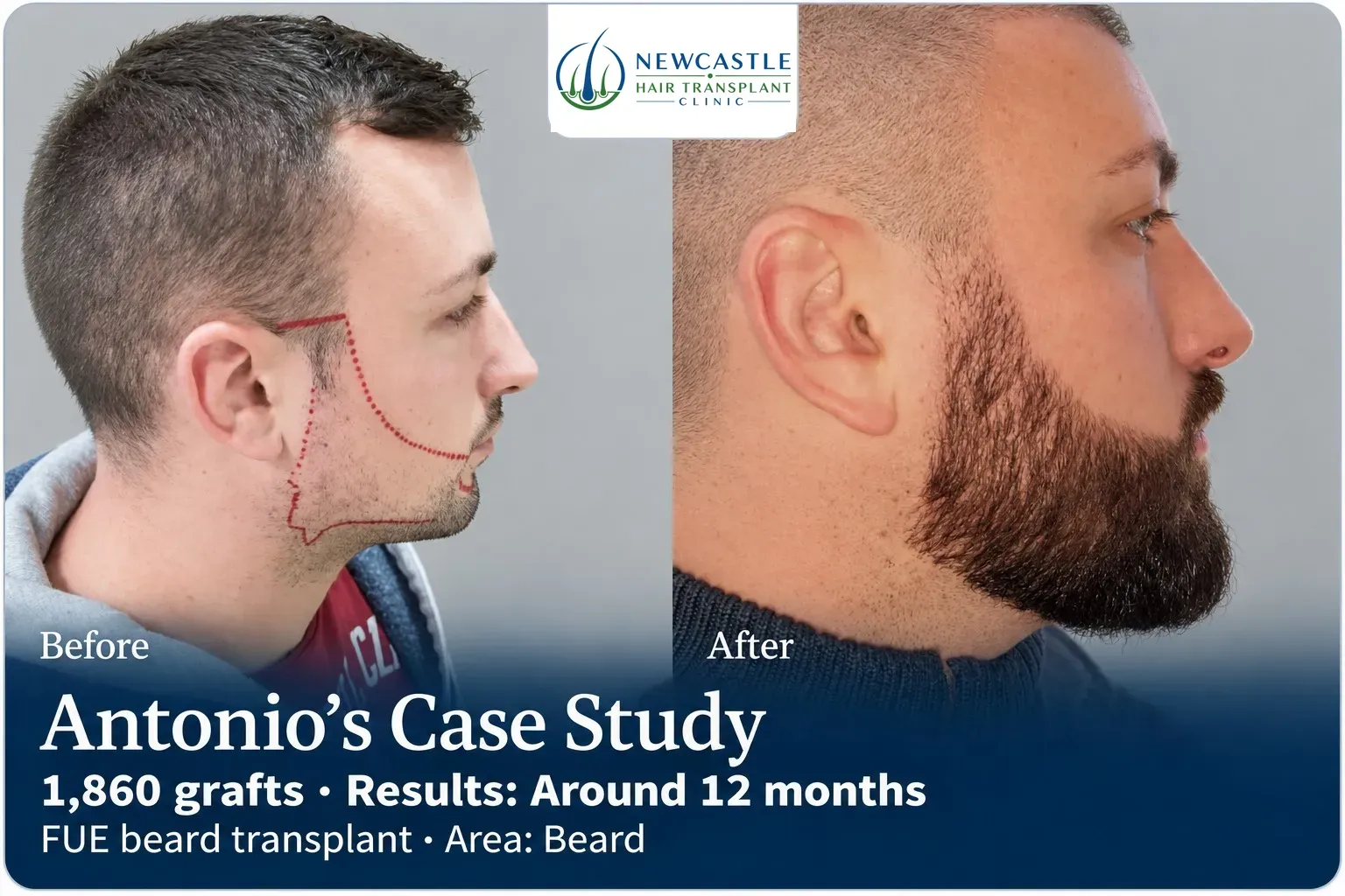 Antonio: FUE beard transplant, Beard, 1,860 grafts, results at 12 months