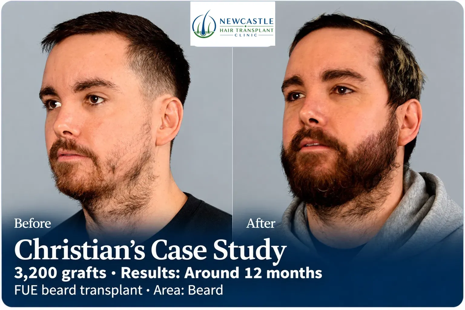 Christian: FUE beard transplant, Beard, 3,200 grafts, results at 12 months