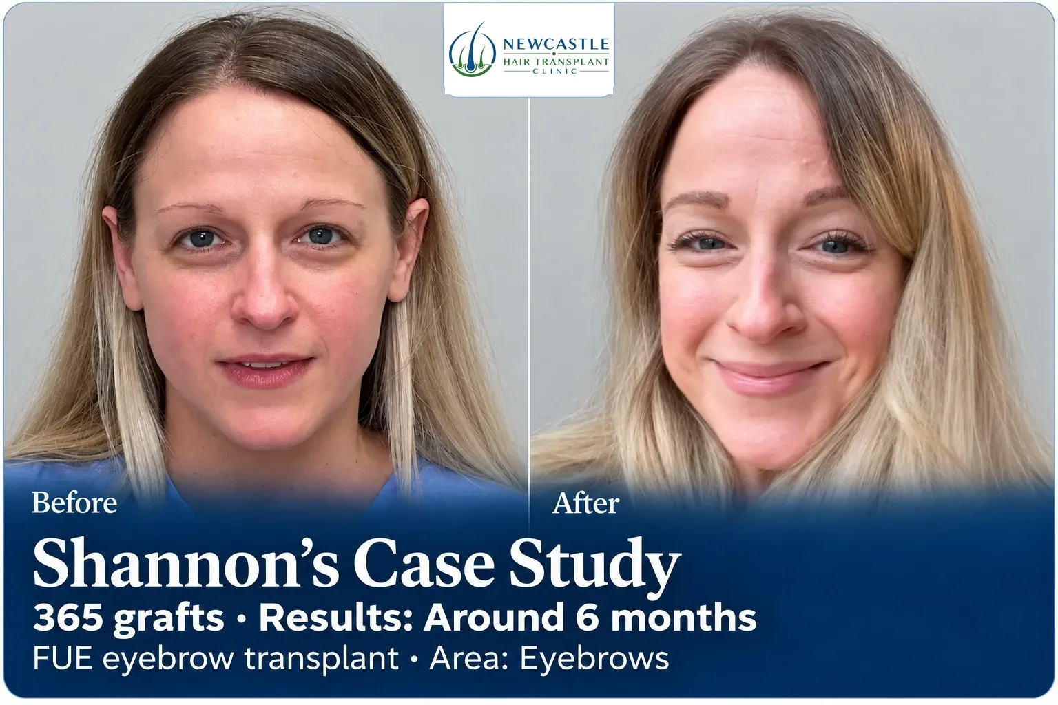 Shannon: FUE eyebrow transplant, Eyebrows, 365 grafts, results at 6 months