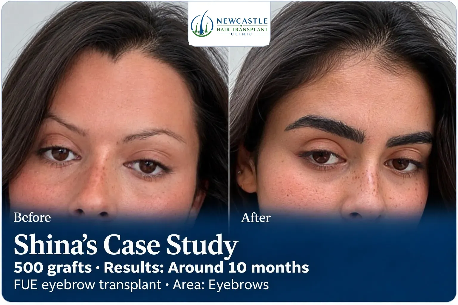 Shina: FUE eyebrow transplant, Eyebrows, 500 grafts, results at 10 months