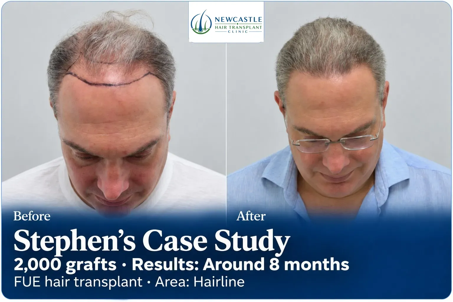 Stephen: FUE, Hairline, 2,000 grafts, results at 8 months