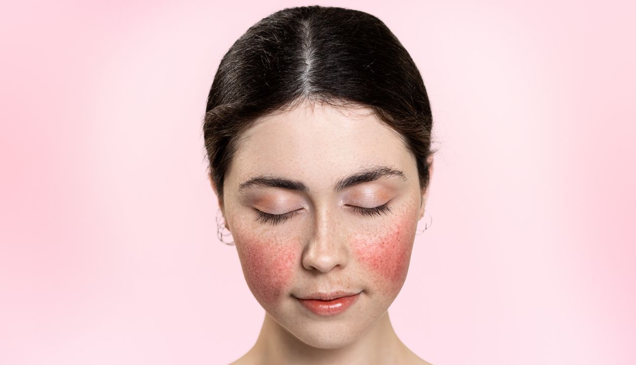 Hva er rosacea og hvordan bli kvitt det