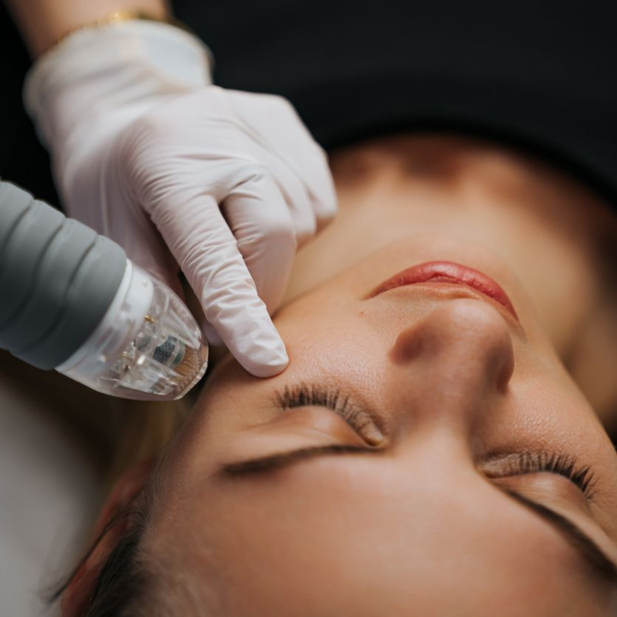 Lutronic Genius RF behandling hos Klinikk Nyhud i Kristiansand