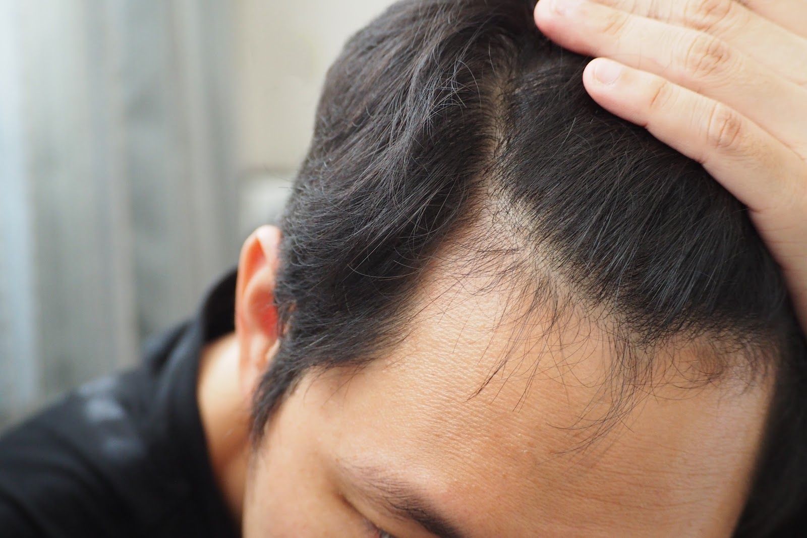 Person holding the top of their head, showing a thinning hairline.