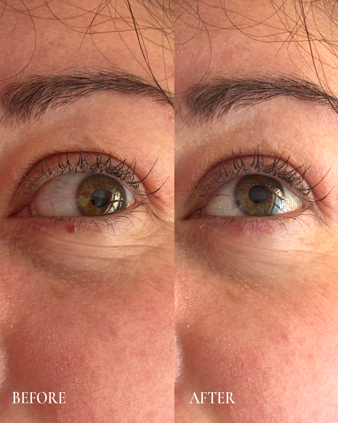 Side-by-side close-up of an eye and cheek, labeled “Before” and “After,” showing reduced under-eye puffiness.