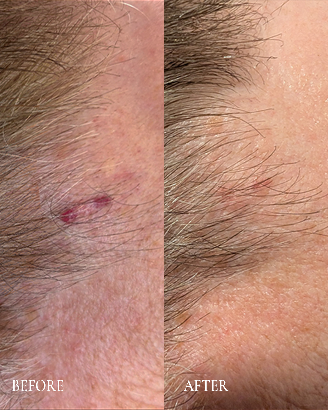 Before-and-after close-up of skin showing a small healed blemish on a hairy area.