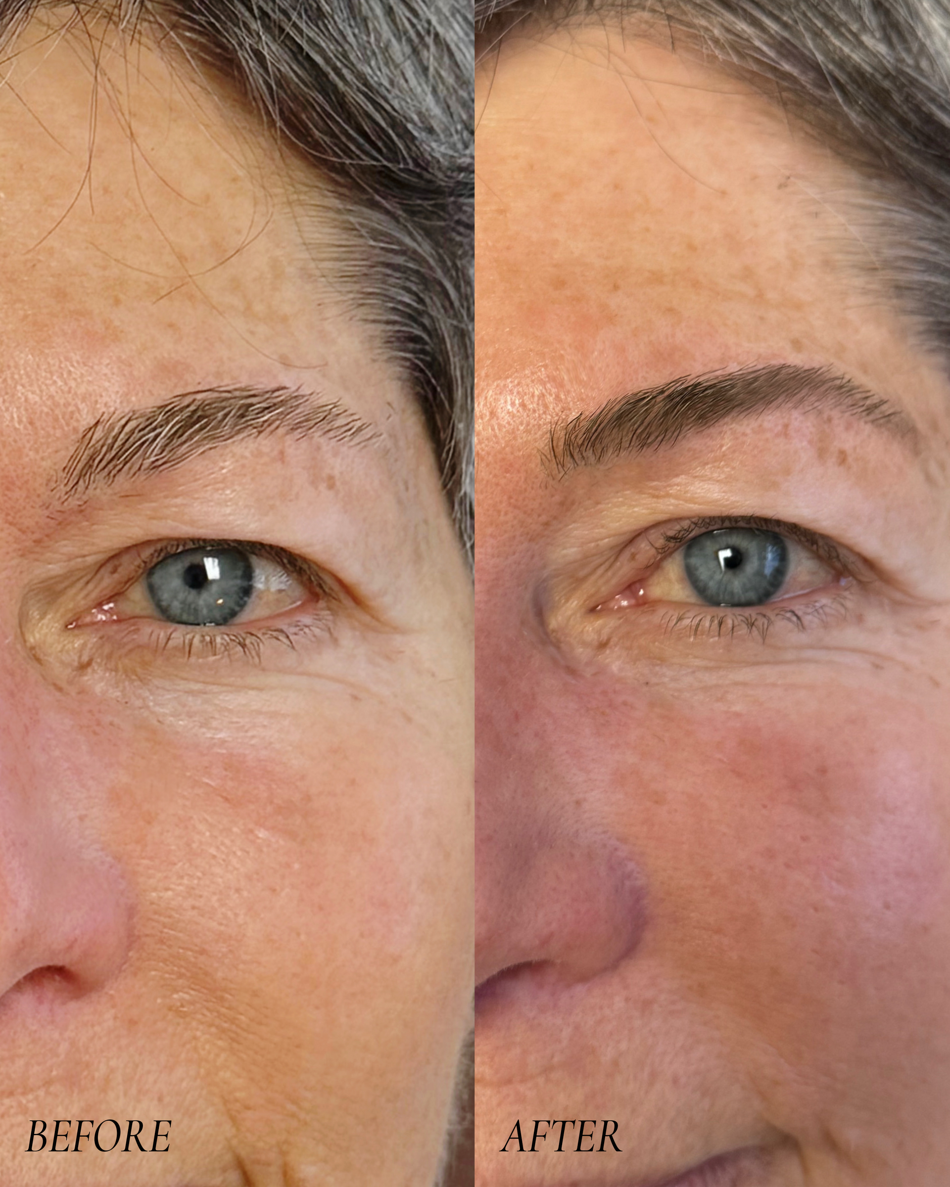 Side-by-side close-up of an eye before and after treatment, showing reduced wrinkles and redness.