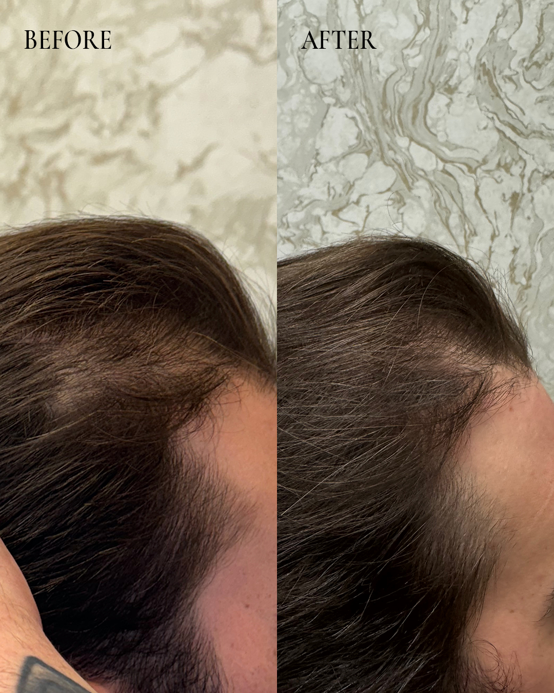 Before-and-after close-up of a woman’s hairline showing thinning hair on the left and fuller hair on the right.