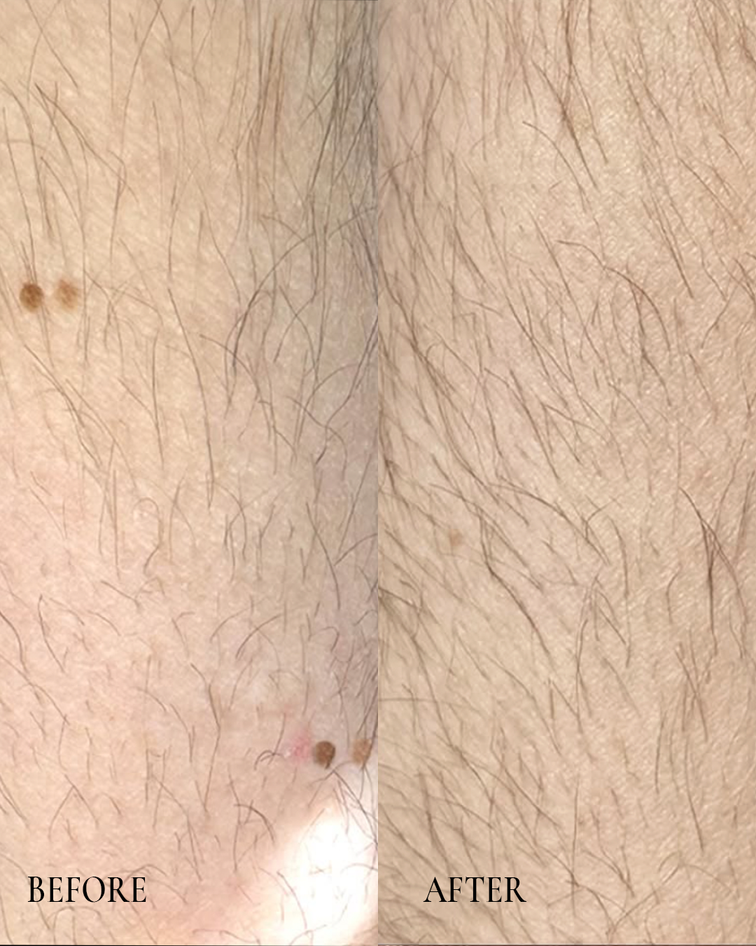 Before-and-after close-up of skin with a small mole removed, labeled “BEFORE” and “AFTER.”