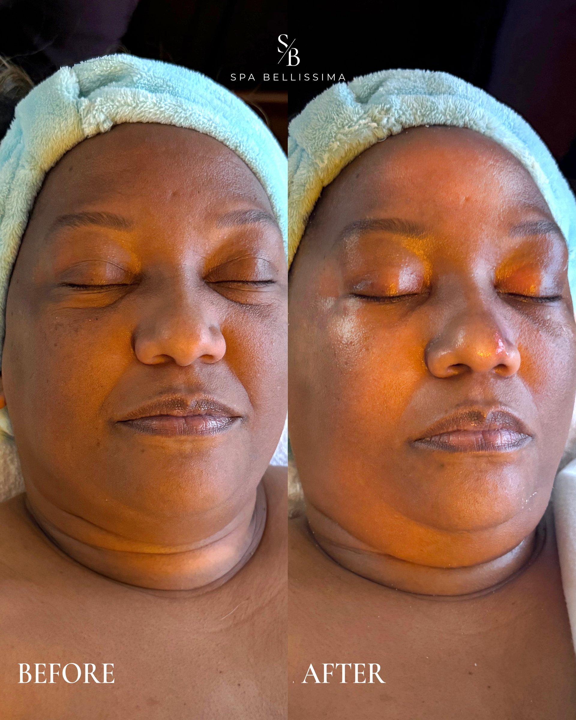 Side-by-side close-up of a face marked “BEFORE” and “AFTER,” with smoother skin in the after image.