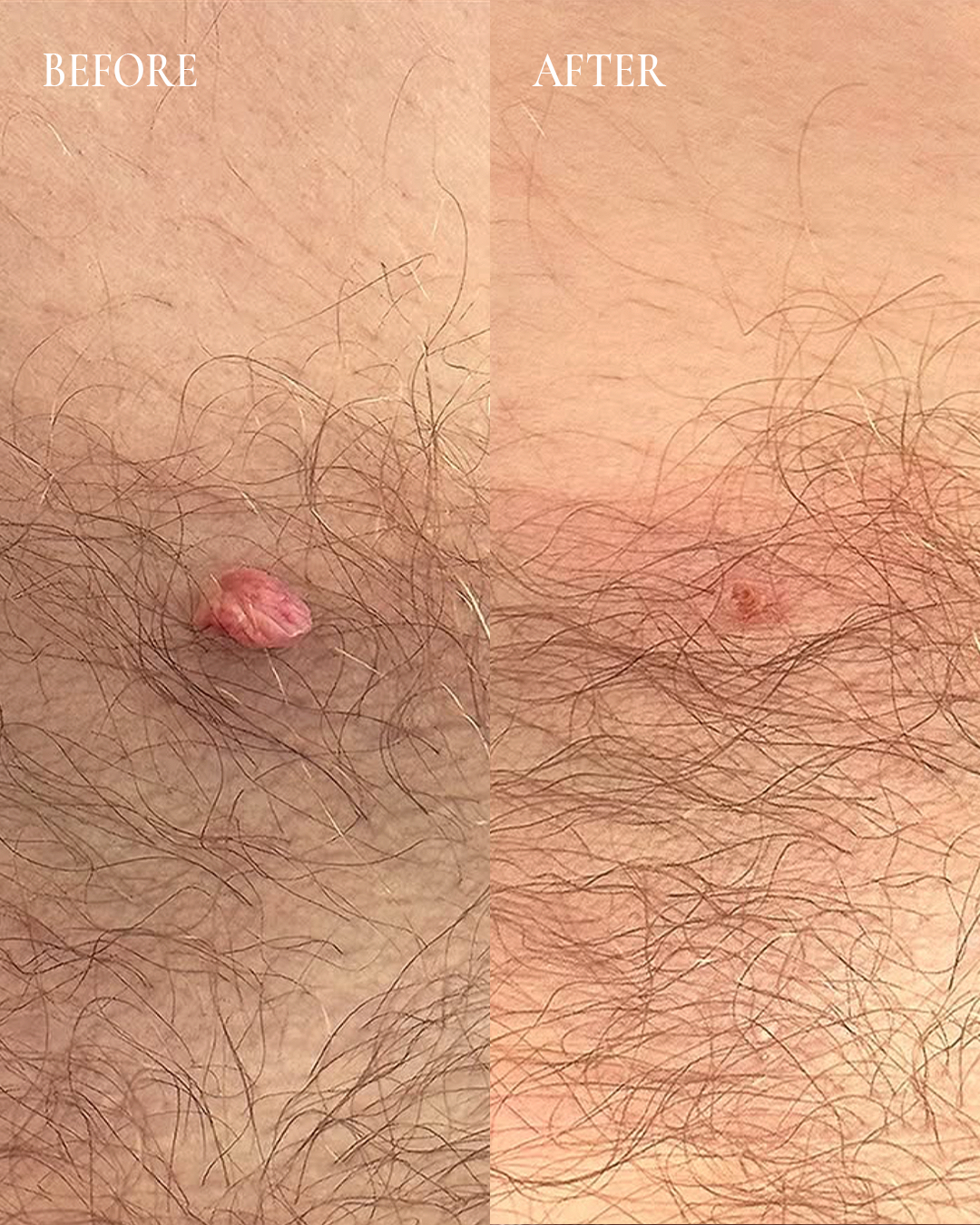 Split image showing a skin bump before and after, with the bump reduced to a flatter pink spot.