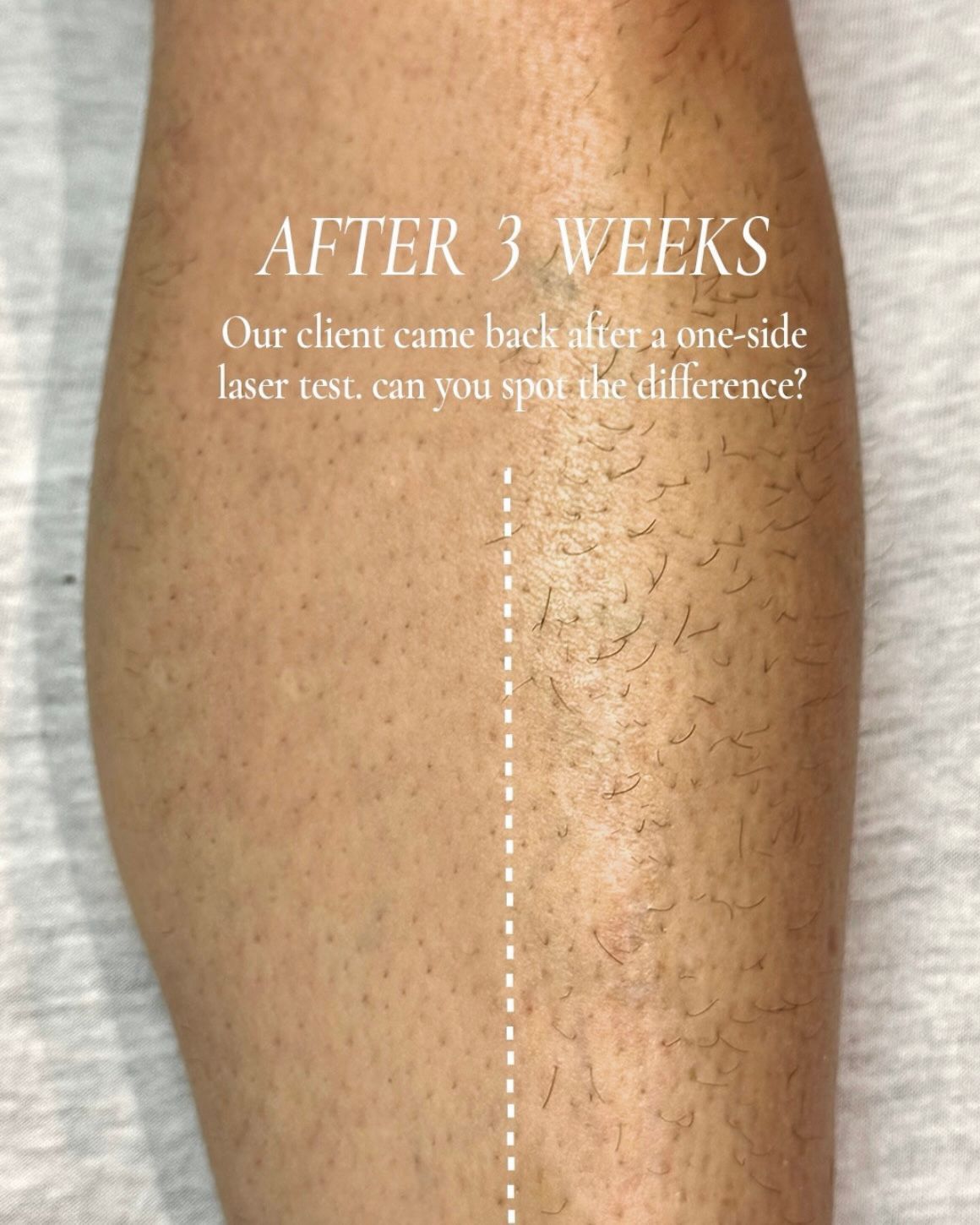 Split-view leg showing reduced hair after one side received laser hair removal for 3 weeks