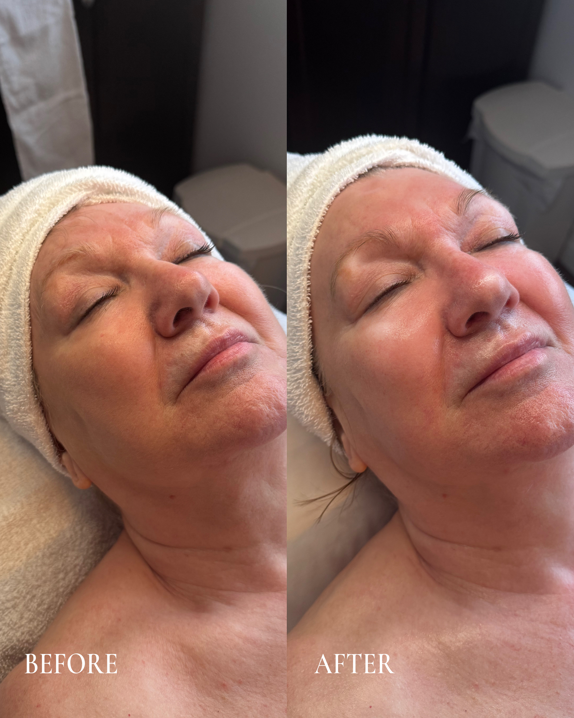 Side-by-side spa facial before and after, showing smoother, glossier skin with a headband and towel wrap.