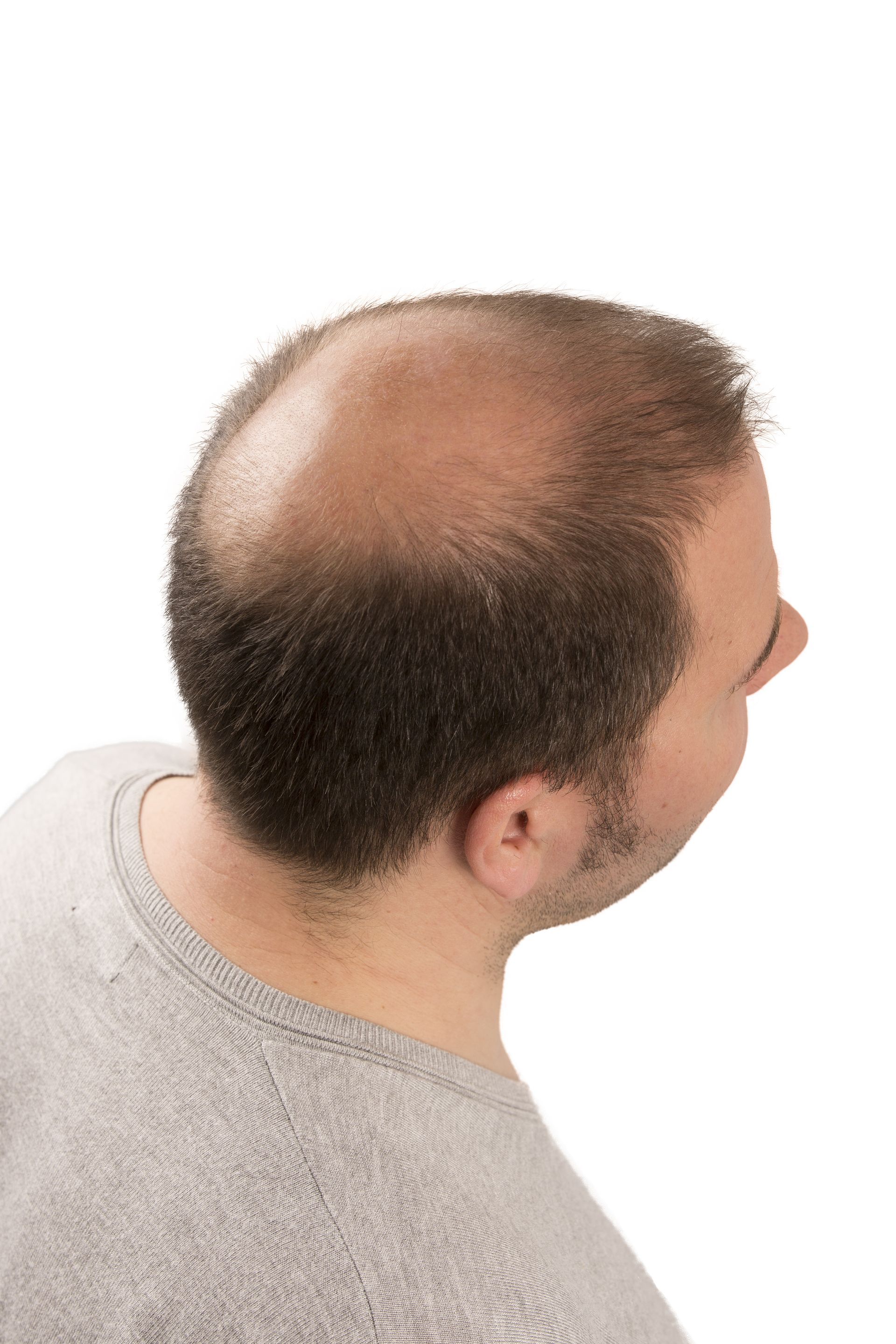 The back of a man 's head with a bald spot on it.