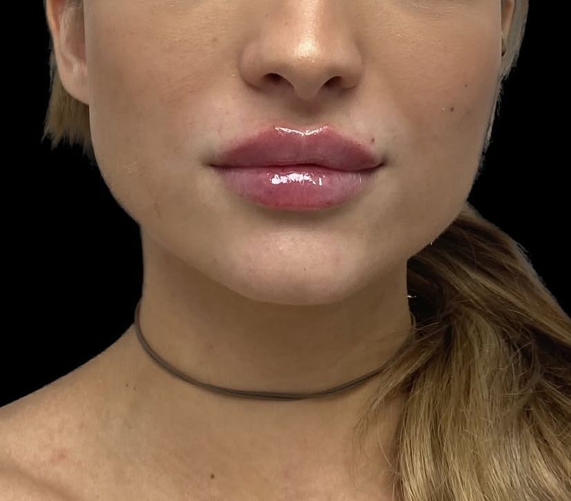 filler 1