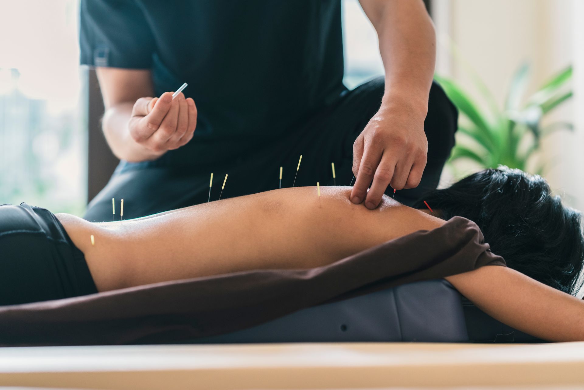 A man is giving a woman an acupuncture treatment on her back.