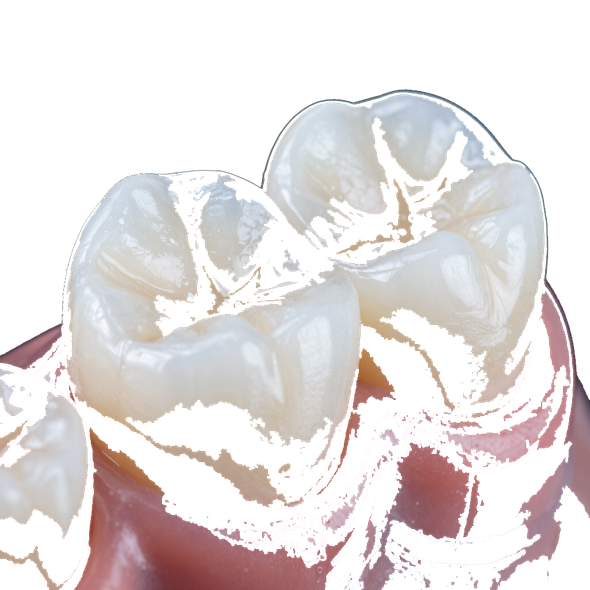 Primo piano di due molari con sigillante dentale bianco o materiale da otturazione sulle gengive
