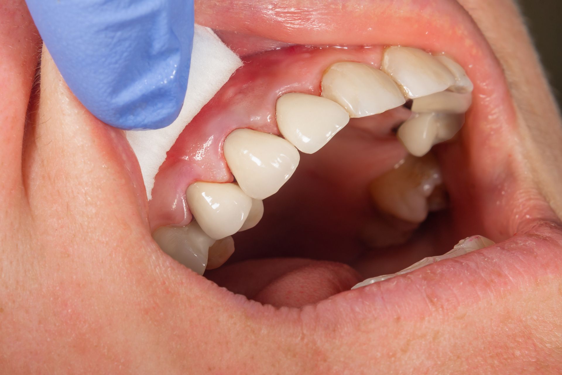 Close-up of ceramic crowns by Magnolia Dental in Fairfax, VA, for high-quality dental care