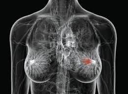 Radiografia del torso femminile con area rossa nel seno destro, che indica un potenziale tumore.