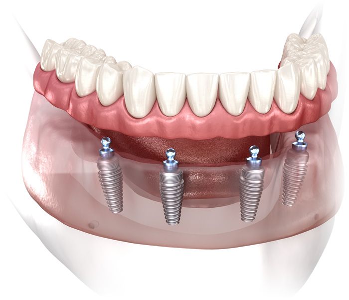 all on 4 dental implants