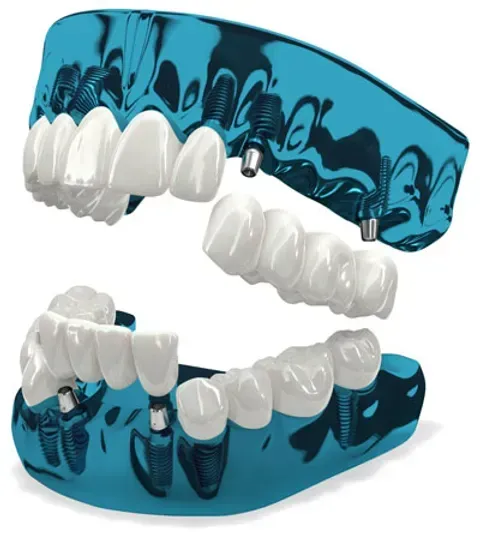 3 on 6 dental implants tampa