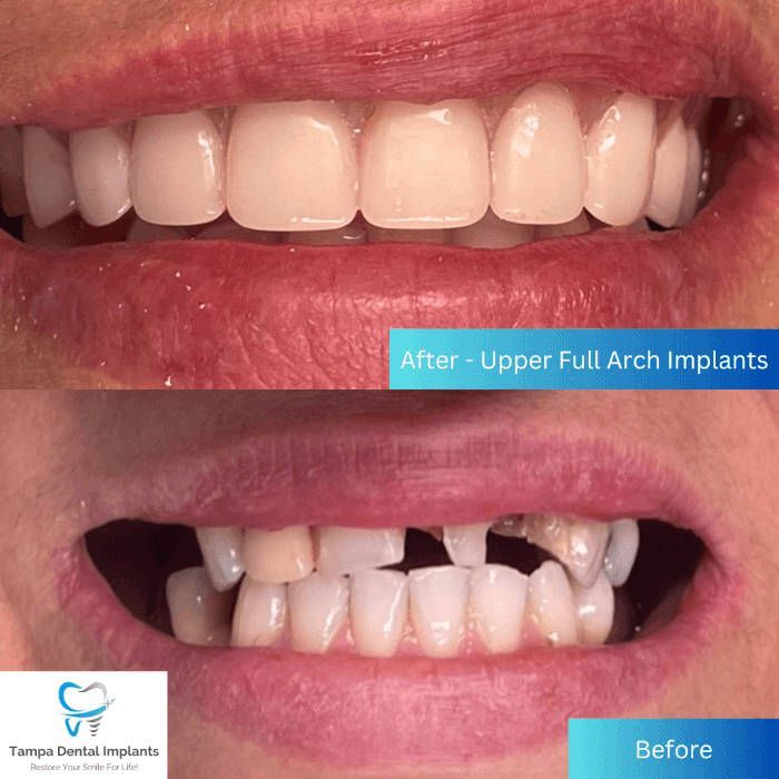before and after upper full arch dental implants
