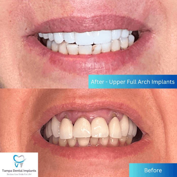 dental implants tampa before and after
