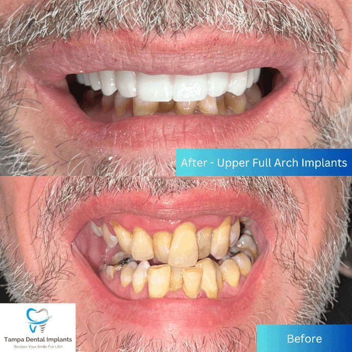 dental implants tampa before and after