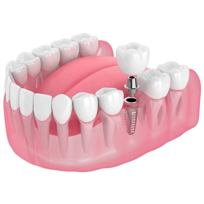 single tooth replacement
