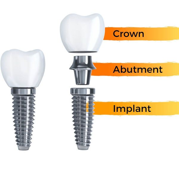 crown implant