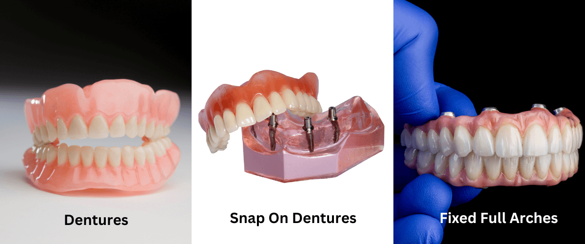 dentures and snap-on dentures