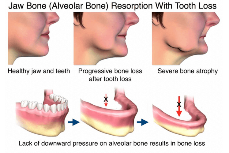 jaw bone